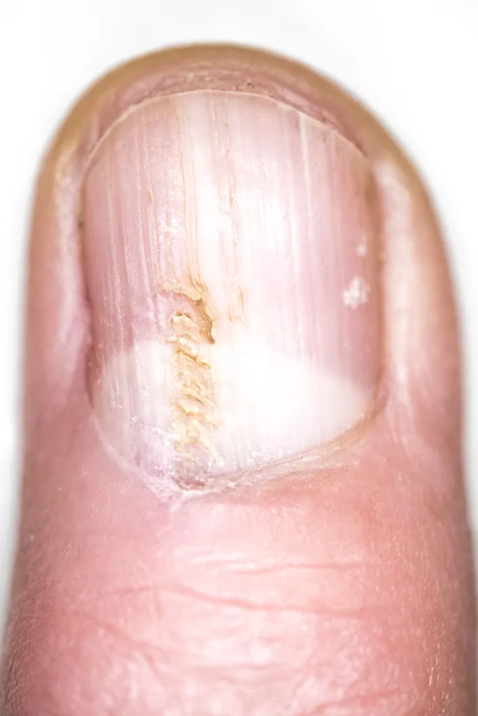 Close-up of a yeast infected nail