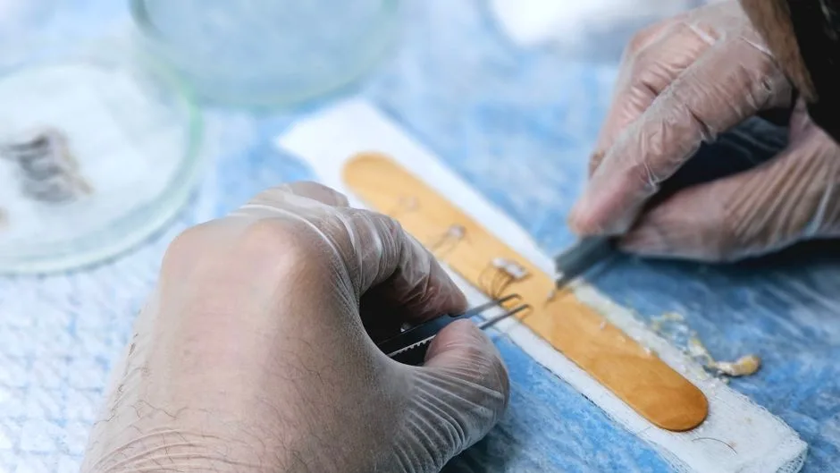 Close-up of surgeons preparing hair grafts for transplantation, demonstrating precise skills.