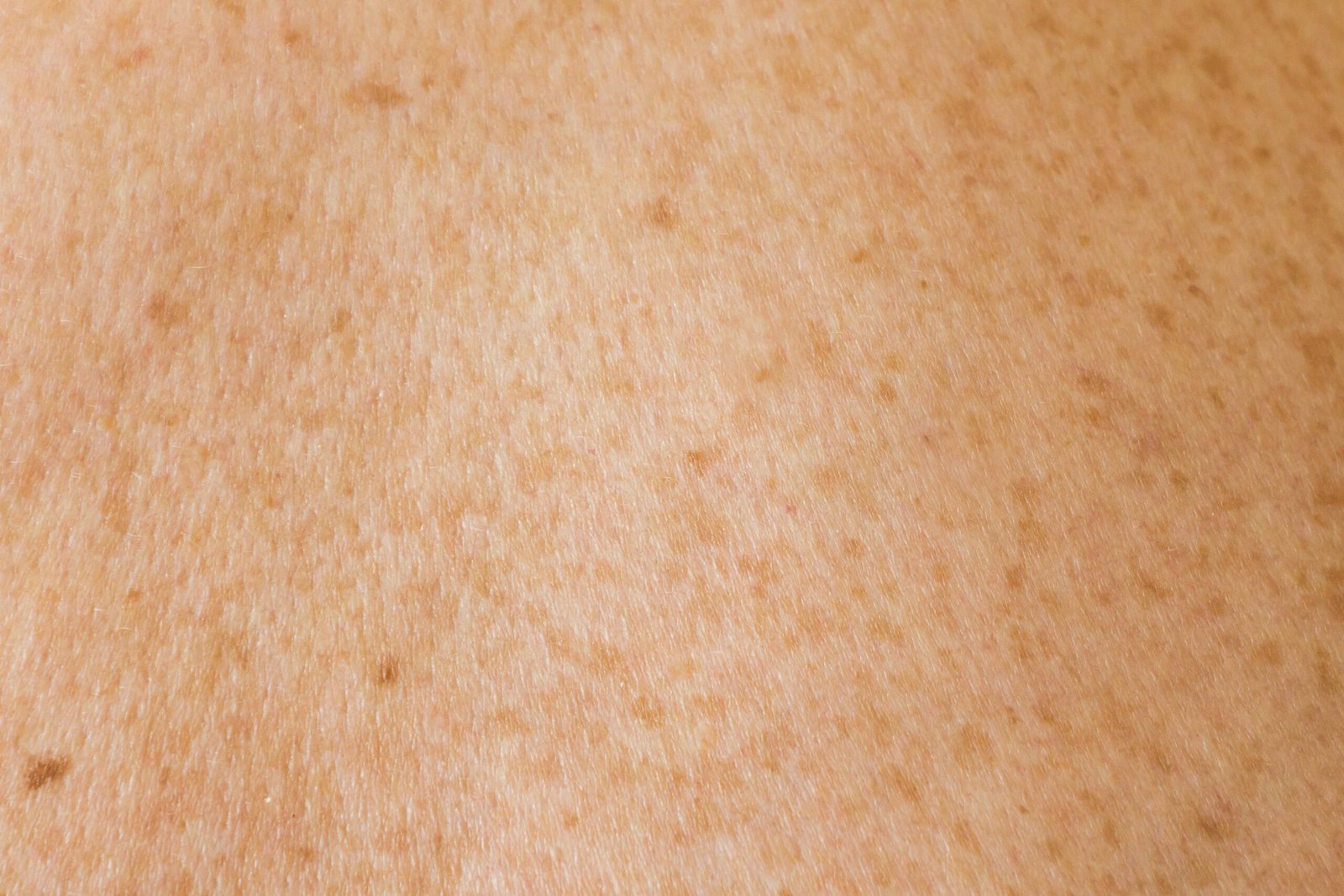 a close up of a person's back with brown spots