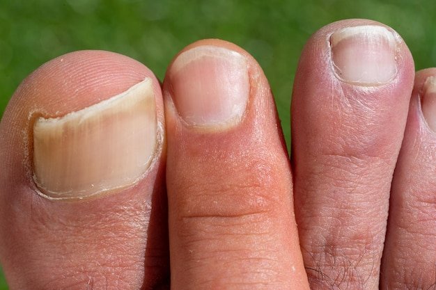 Thickened Yellow Toenails